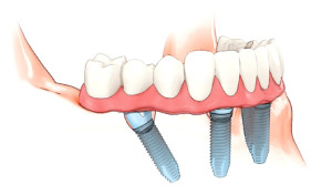 Zygoma